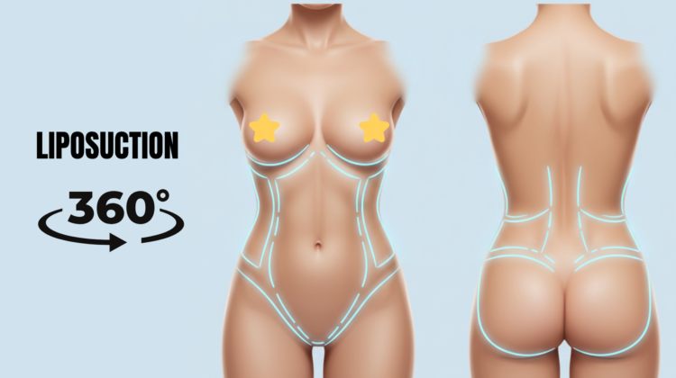 Liposuction 360