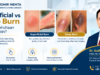 superficial vs deep burn