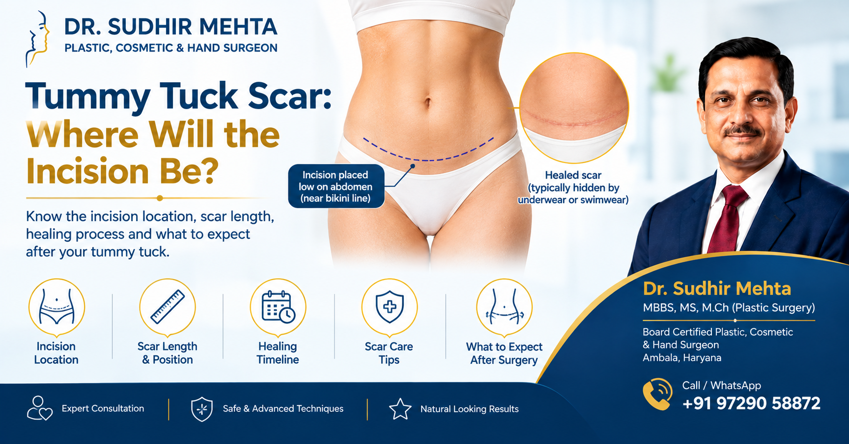 tummy tuck scar